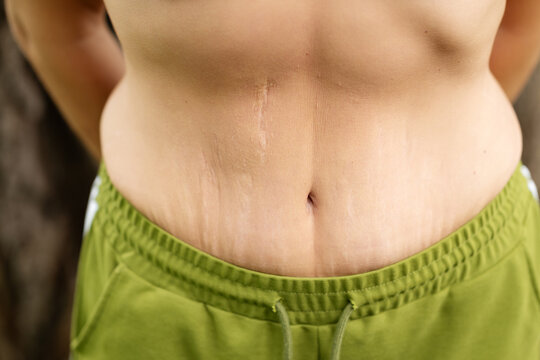 Close up of female abdomen with stretch marks and surgical scar on skin. Medical and aesthetic concept of postpartum striae, skin scars, body positivity and dermatology.