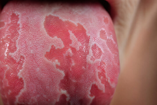 Geographic Tongue Close Up Macro Showing Migratory Glossitis on Human Tongue