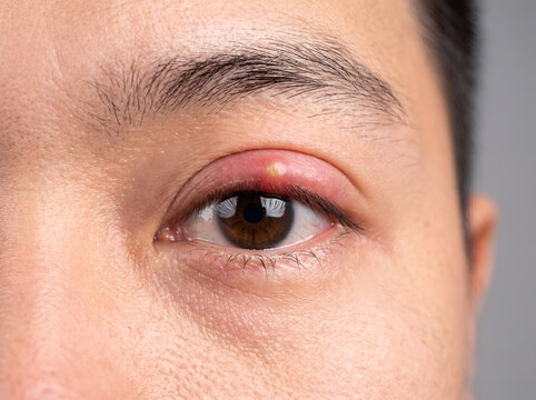 Extreme close-up of an acute stye with a visible yellow pus point on a person's upper eyelid.