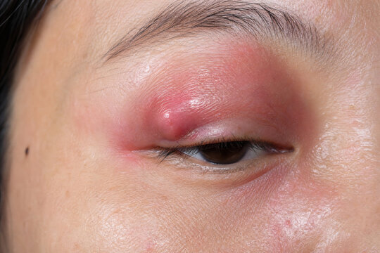 Inflamed Chalazion on Upper Eyelid with Redness and Swelling Close Up Medical Image