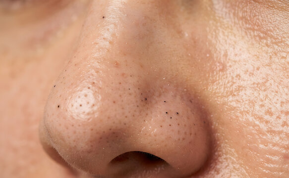 Macro texture of oily facial skin with enlarged pores and blackheads