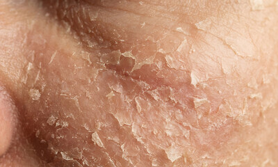 Fototapeta premium Macro texture of severely dry, flaky, and dehydrated facial skin