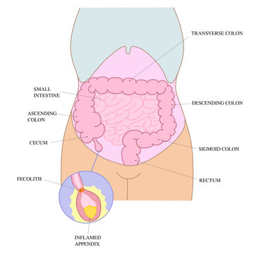 Appendicitis Anatomy Diagram