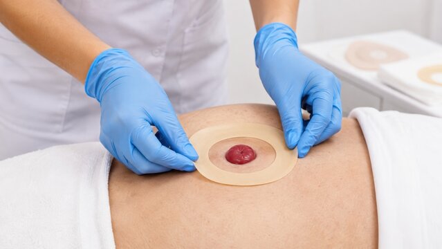 Nurse applying skin barrier ring around a stoma on patient's abdomen