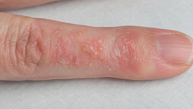 Dyshidrotic eczema flare with tiny blisters on finger