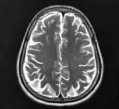 Magnetic resonance image (MRI) of the brain. MRI scan of human brain with black background.