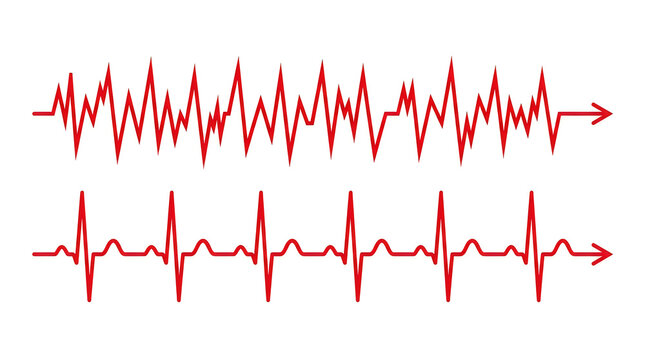 Comparison of irregular and regular heartbeat rhythm on white background