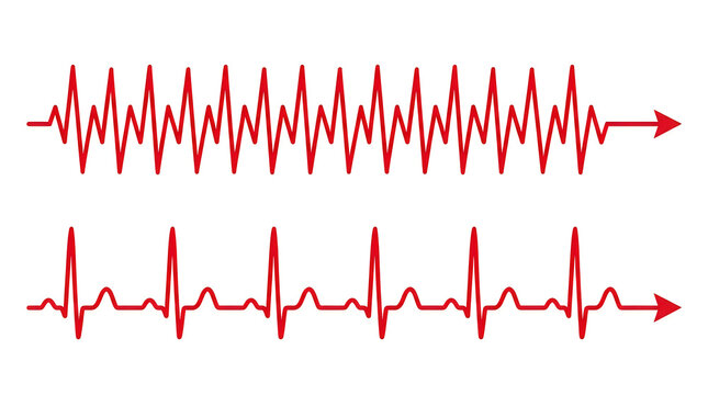 Comparison of tachycardia and normal sinus rhythm heart rate electrocardiogram ecg tracings