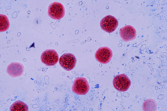 Micrograph of Cyclospora cayetanensis oocysts in a stool sample, stained magenta using modified acid-fast stain. This foodborne parasite causes diarrhea outbreaks linked to contaminated produce.