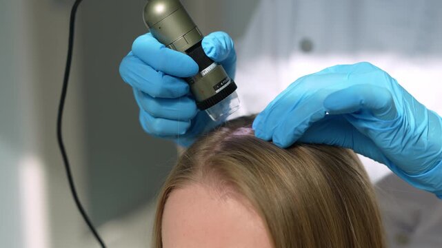 Trichologist examining patient scalp with a digital dermatoscope in a clinic 4k video. Scalp examination by a dermatologist using a handheld trichoscope device