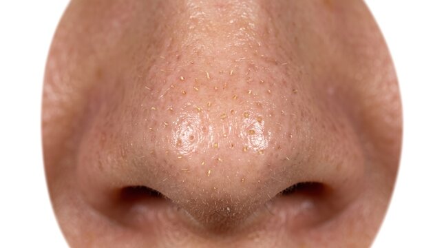Macro close up shot of human nose tip showing open pores filled with visible white sebaceous plugs