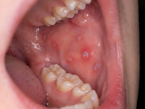 Clinical View of Koplik Spots on Buccal Mucosa Indicative of Measles Infection