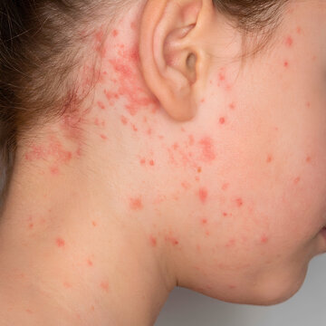 Close-up of a child with a skin rash and red spots on the face and neck