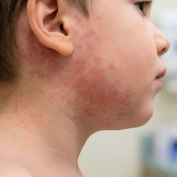 Child with a facial rash showing signs of skin inflammation and irritation