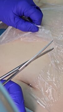 Professional removal of papillomas and moles with electrocoagulation procedure in dermatology clinic. overweight European woman on the surgical table. moles papillomas neoplasms on the body