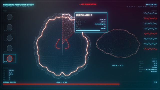 Animated cerebral perfusion scan analyzes frontal lobe activity on a futuristic medical dashboard, creating a precise cinematic visual for healthcare marketing.