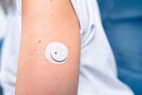 Continuous Glucose Monitor Sensor Attached to Arm for Diabetes Care