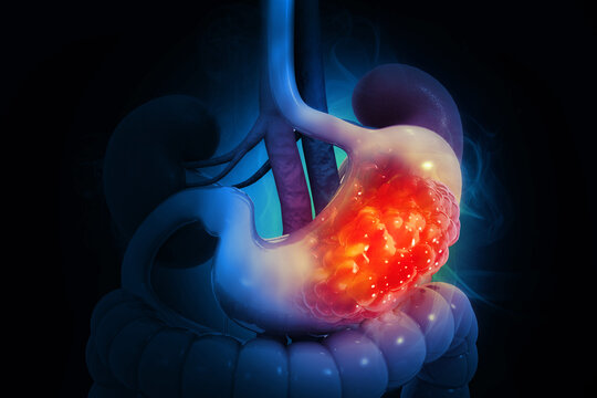 stomach cancer or gastric cancer with organs and tumors. cancerous cells 3d illustration
