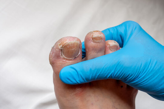 Podiatry Examination of Male Foot with Toenail with Medical Gloves