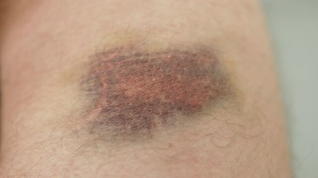Gradient hematoma on hairy leg of caucasian man close up. Large bruise and painful injury from sportsman fall. Consequences of fight and unlawful actions of third parties.