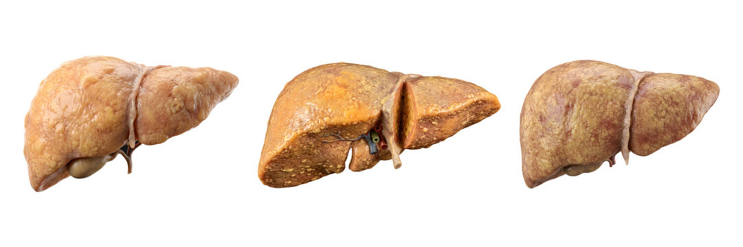 PNG Fatty Liver Disease Anatomy Collection Isolated on Transparent Background