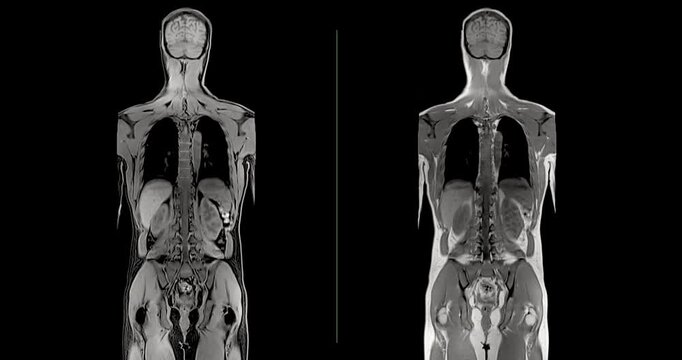 Wide grayscale footage of a whole body magnetic resonance imaging examination scrolling through coronal slices from chest to spine on a clean black background.