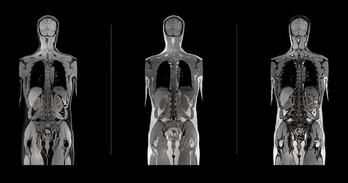 Wide medical animation showing a complete whole body MRI study cycling through coronal slices of brain chest abdomen and pelvis over a dark background.