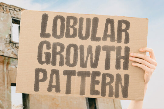 "Lobular Growth Pattern" Invasive lobular carcinoma spreads in a linear fashion. LOBULAR. HISTOLOGY. DIFFUSE. INFILTRATION. STAGING.