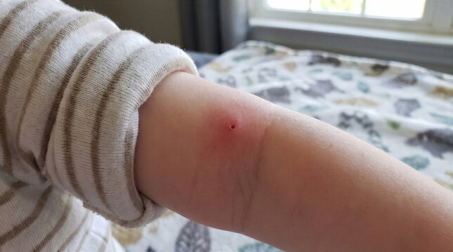 Mosquito insect bite with red swollen skin mark on a child arm
