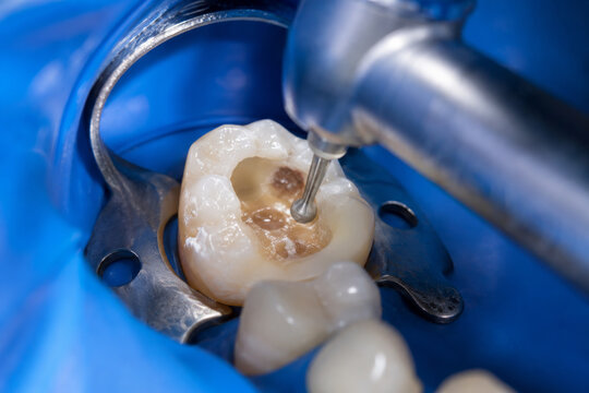 Close-up of endodontic cavity preparation and caries removal on a human tooth isolated with a blue rubber dam during a procedure.