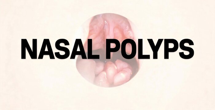 Graphic illustration of nasal polyps, a medical condition affecting the nasal cavity.