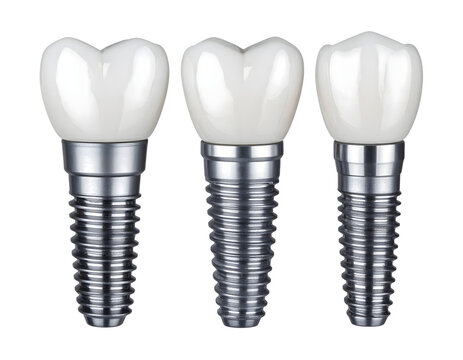 Dental implants set featuring three white prosthetic teeth with metallic titanium screws for modern oral surgery on transparent background