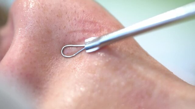 Blackhead Extraction With Comedone Loop Near Nose