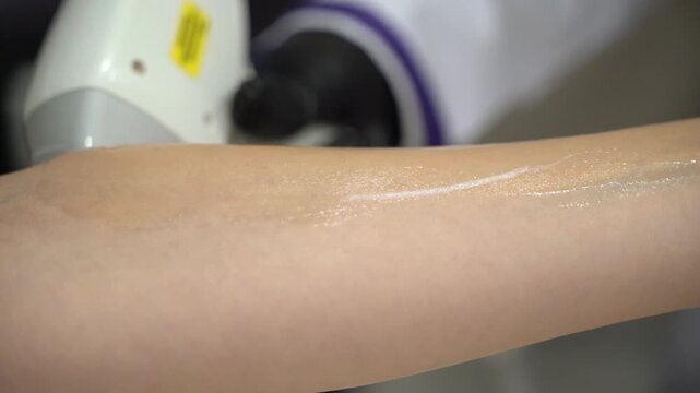 Laser Hair Removal Treatment on Gel Covered Forearm