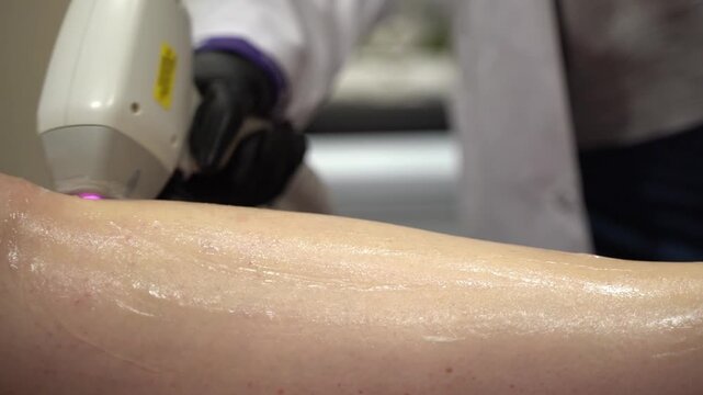 Gloved Hand Applying Laser Hair Removal Device