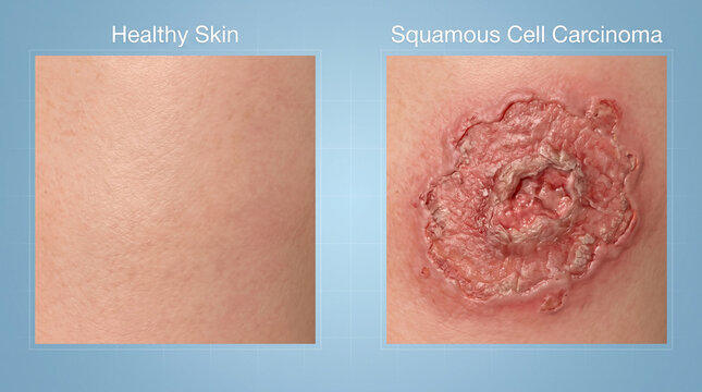 Healthy Skin vs Squamous Cell Carcinoma Skin Cancer Comparison