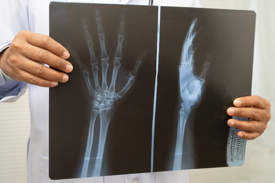 Doctor examining hand ankle joint bone radiography xray film.