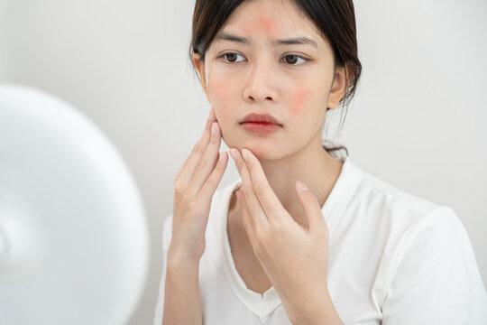 Young woman asian are worried about faces Dermatology and allergic to steroids in cosmetics. sensitive skin, red face from sunburn, acne, allergic to chemicals, rash on face. skin problems and beauty