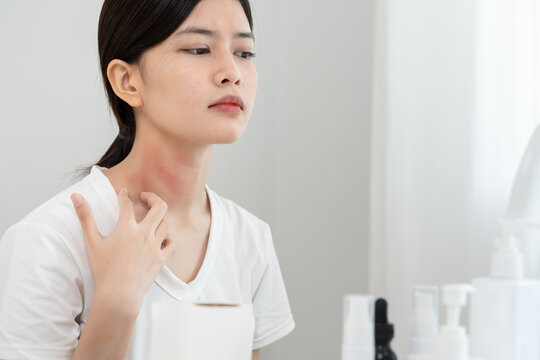 skin problem and beauty. Young woman scratch body has itchy skin from skin allergic, steroid allergy, sensitive skin, red from sunburn, chemical allergy, rash, insect bites, Seborrheic Dermatitis.