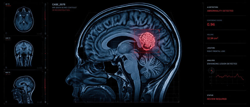 Brain MRI medical healthcare diagnostics AI tumor scan abnormality lesion frontal lobe contrast analysis detection volume sagittal coronal axial