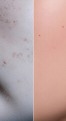 Fototapeta premium Close-up of skin texture, showing moles and pores, a representation of human biology and health