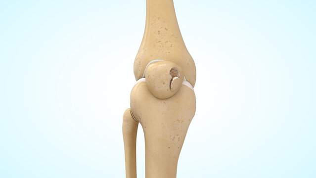Osteochondral patella fracture of 3d illustration