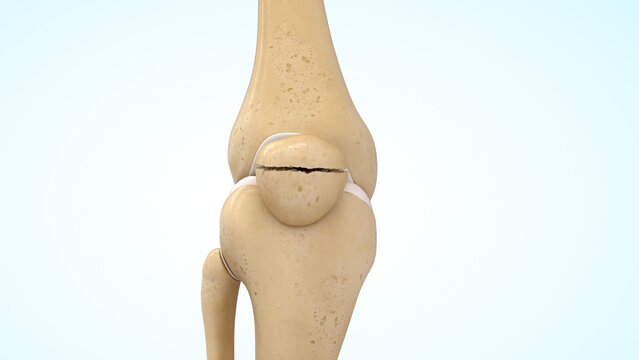 Transverse patella fracture of 3d illustration