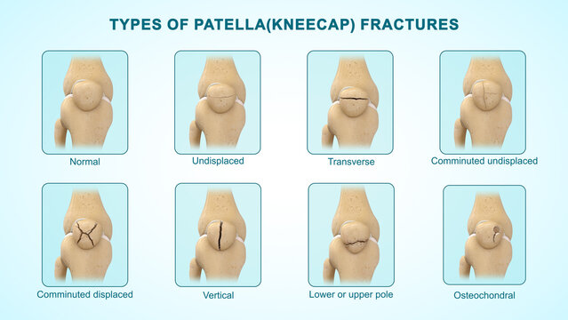 Types of patella(kneecap) fractures of 3d illustration