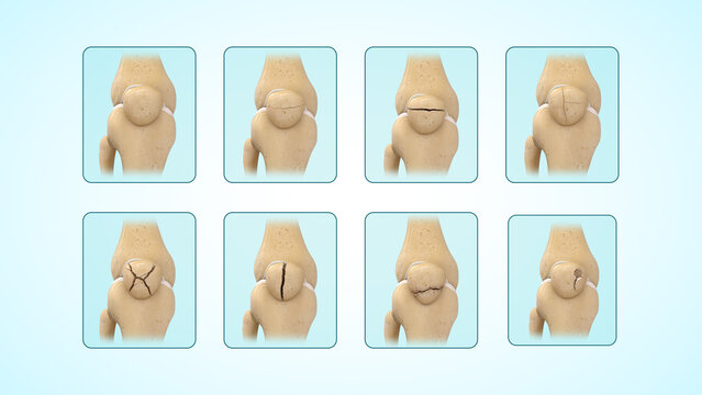 Types of patella(kneecap) fractures of 3d illustration
