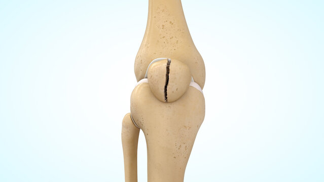 Vertical patella bone fracture of 3d illustration