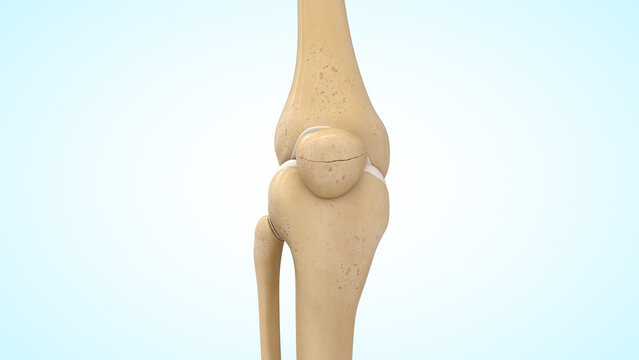 Undisplaced patella fracture of 3d illustration
