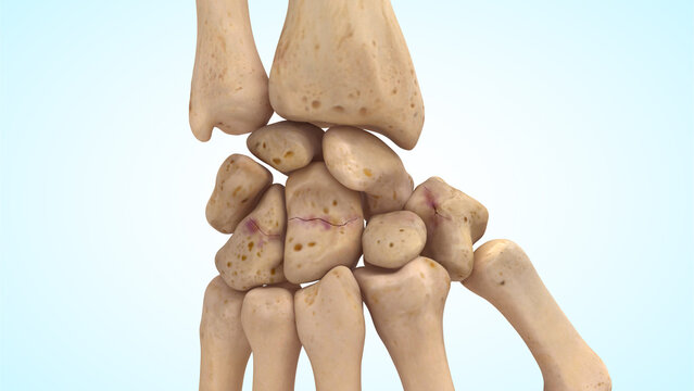 Carpal bones non displaced bone fracture fracture of 3d illustration