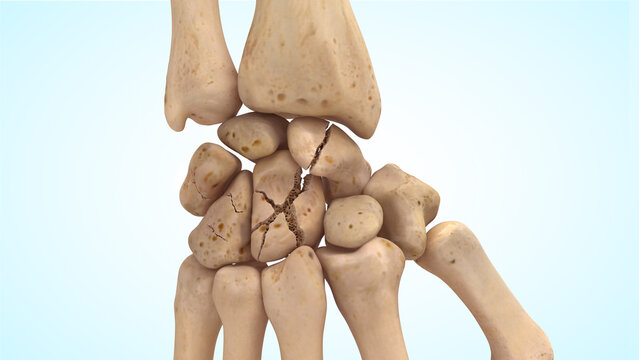Displaced fracture of the wrist carpal bones 3d illustration