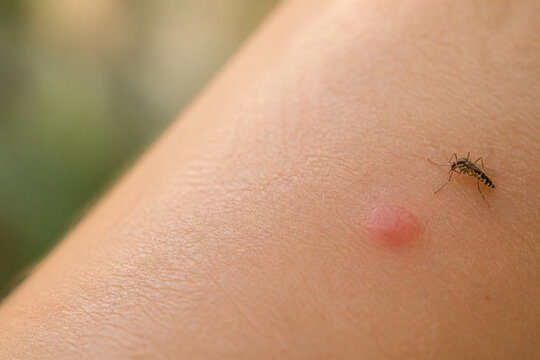 Mosquito bite bump and tiny mosquito on skin, pest irritation and health risk concept
